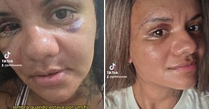 Juliana Soares, agredida com 61 socos, mostra rosto após um mês de cirurgia de reconstrução