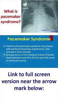 What is pacemaker syndrome?