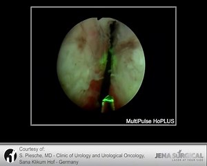 Holmium Laser Enucleation of the Prostate (HoLEP)