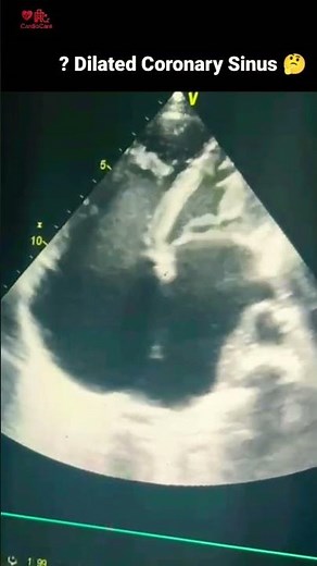RA RV dilated RV dysfxn present Prominent Mode. band noted in RV Floppy IAS #echocardiography