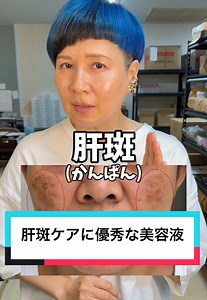 肝斑の原因の殆どはホルモンバランスの乱れです。なので、産後や更年期などのホルモンバランスが乱れやすい時期の女性に多く発症します。ホルモンバランスの乱れを腸から改善していく当店の最強の腸活もオススメです^_^#シミ #肝斑 #スキンケア