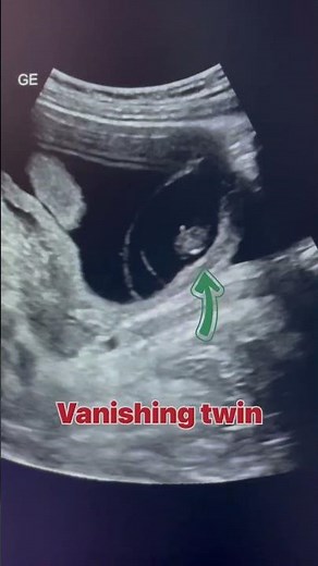 Vanishing twin #radiology #ultrasound #sonography #ultrasonography