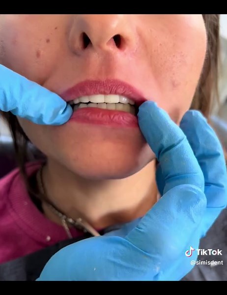 ΜΕΤΑΜΟΡΦΩΣΗ ΣΤΟΜΑΤΟΣ ΜΕ ΕΜΦΥΤΕΥΜΑΤΑ Άλλη μία μεταμόφωση στόματος με εμφυτεύματα και δόντια πορσελάνης ολοκληρώθηκε σήμερα! Η διαδικασία ανώδυνη και χωρίς πόνους και οιδήματα καθώς όλα έγιναν μετά από φυγοκέντριση του αίματος της ασθενούς και χρήστη αυτόλογων βλαστοκυττάρων! Growth factors & CD4 stem cells The future in Oral Implantology & Periodontology __________________________________________ 📍Σολιώτη 55, Αμπελόκηποι, Αθήνα, ΤΚ 11522 (Πλησίον μετρό Αμπελόκηποι) ☎️ 2106456105 Σας περιμένουμε 