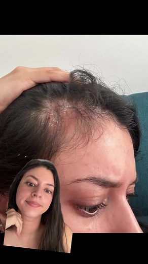 Como solucione mi problema de caspa en solo 3 dias, la cremita se llama Clobetasol propionato #greenscreen #caspa #dermatitis #dermatitisseborreica