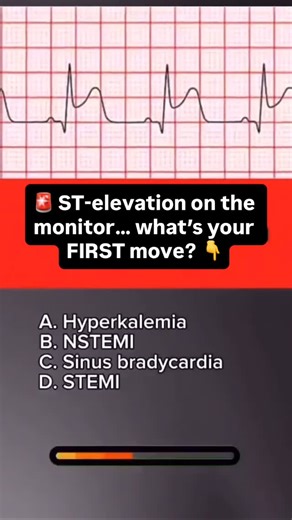 CriticalCareRN-Friend on Instagram: "🚨 ST-elevation on the monitor… what’s your FIRST move? 👇 STEMI = Time is myocardium ❤️ See tombstones? 📈 Confirm with a 12-lead ASAP • Don’t rely on a single lead strip You should already be moving. First priority: Assess your patient 🫁❤️🧠 🩺 Focused Assessment • Are they conscious? • Any chest pain? • SOB, diaphoresis, nausea? • Check pulses & perfusion • Apply defib pads now 📊 Get full vitals • Look for hypotension • Monitor O₂ & work of breathing 📞 