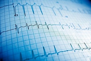 Sick Sinus Syndrome | Family Doctor