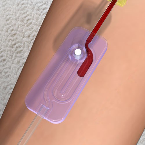 Kurin Lock™ has passive Flash Technology designed for seamless use by clinicians. Check it out! | Kurin