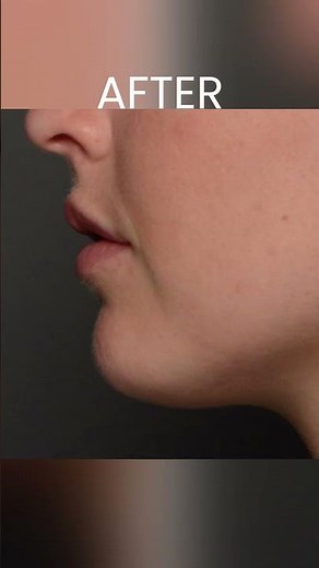 Chin Filler Before and After Facial Transformation #cosmeticdermatology #injectablefillers