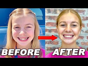 Braces Taken Off After 2 YEARS!