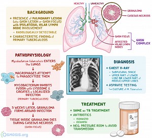 Ghon Complex: What Is It, Causes, Diagnosis, Treatment, and More | Osmosis