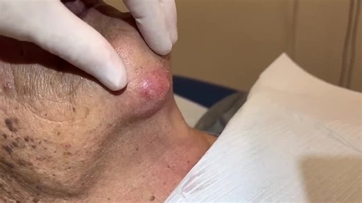 Giant inflamed tender abscess on chin. I open it and drain it