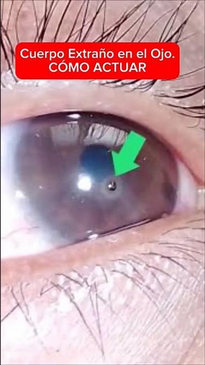 Cuerpo Extraño en el Ojo. CÓMO ACTUAR #oftalmologia #cuerpoextraño #vision #ojo #saludocular