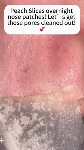 Overnight Nose Pore Strip for Blackhead Removal!#porestrip #blackheads #beautytreatment