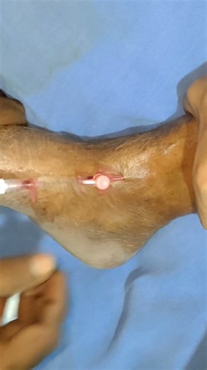 How to quickly do cannula on leg