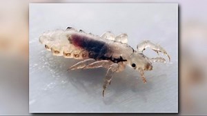 'Super lice' crawl into 48 states; you can stop 'em dead