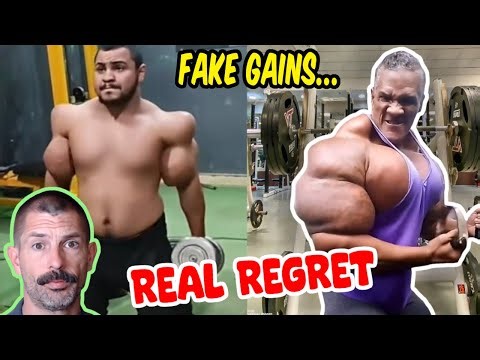 Unbelievable Synthol Fails - Fake Muscle Madness