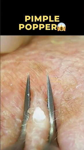 Most Satisfying Pimple Pop Ever!
