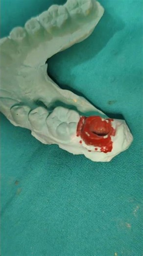 pfm Endocrown