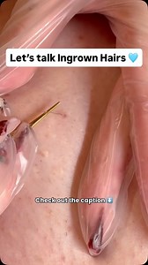 Things We’re Leaving in 2025: Ingrown Hairs. ⬇️ Ingrown hairs are incredibly common and affect people of all skin and hair types. They occur when a hair bends or curls back and grows into the skin instead of rising above it, forming a bump. Ingrowns most often appear on the face, neck, legs, and pubic area, especially after shaving or waxing. These can become more than just a minor annoyance. Beyond the physical discomfort, ingrowns can take a real toll on your confidence. The good news? You’re 