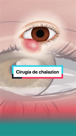 Cirugía de Chalazion: Procedimiento y Recuperación