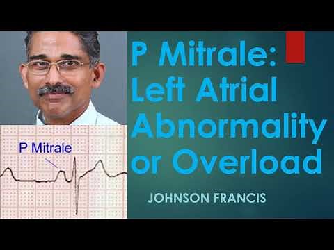 P Mitrale – Left Atrial Abnormality or Overload