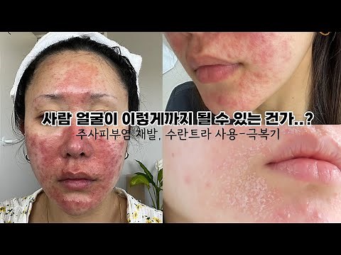 주사피부염 재발 후 역대급 대폭발! 드디어 수란트라 사용기 - 낫는 과정