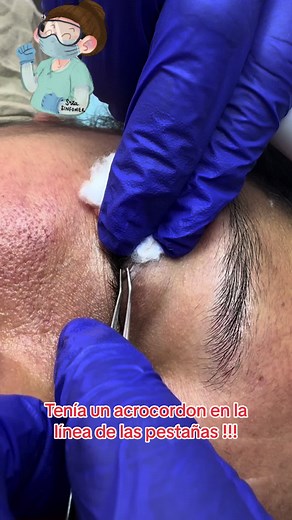 Retiro de acrocordones en los ojos con Melissa