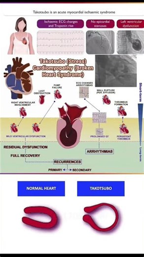 Takotsubo Cardiomyopathy: The Science of Heartbreak
