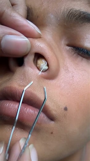 This Nose Blackhead Removal Is SO Satisfying! 😱