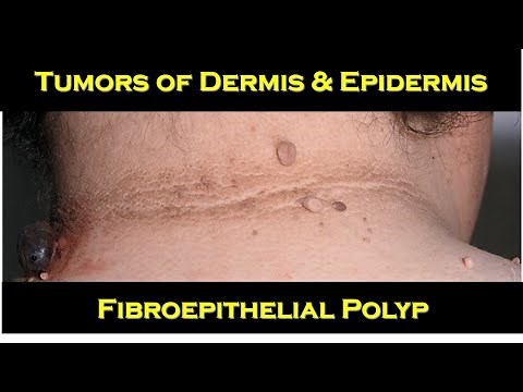 8c - Fibroepithelial polyp