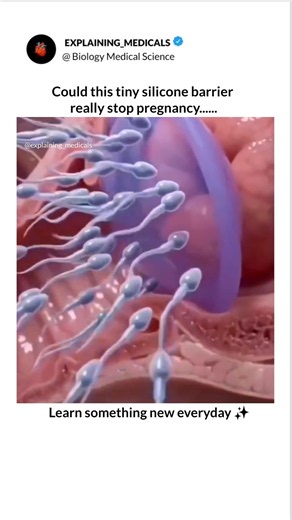 This rubber stops pregnancy.#Contraception #BirthControl #PregnancyPrevention #mbbs #siliconebarrier