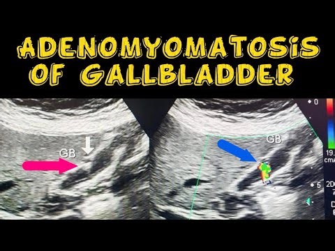 Adenomyomatosis of Gallbladder