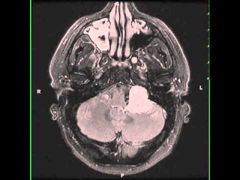 Jugular Foramen Schwannoma, left