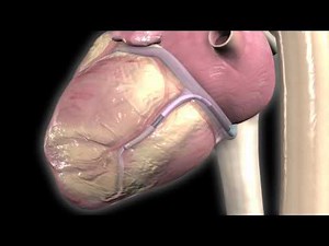 Medtronic's Attain Ability