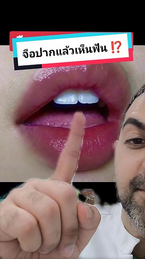 ใครอยากมีฟันน่ารักๆแบบนี้บ้างครับบ 🥰✨ #onlyatSmileBox #smileboxclinic #คลินิกทันตกรรมสไมล์บ็อกซ์ #หมอวิก #หมอฟัน #หมอฟันtiktok #ทำวีเนียร์ที่smilebox #วีเนียร์smileboxclinic #วีเนียร์ฟันขาว #วีเนียร์เซรามิก #ฟันขาว #ฟันเหลือง #กรีนสกรีน