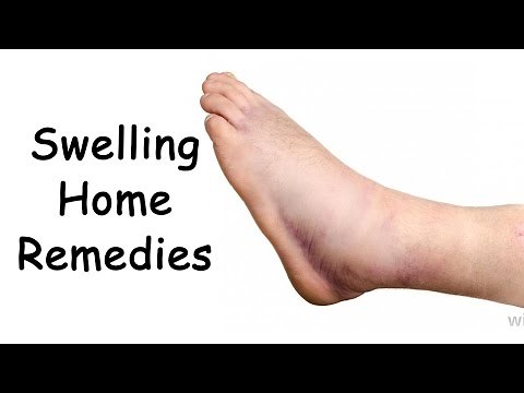 Edema Treatment With 3 Easy Natural Remedies By Sachin Goyal @ ekunji.com