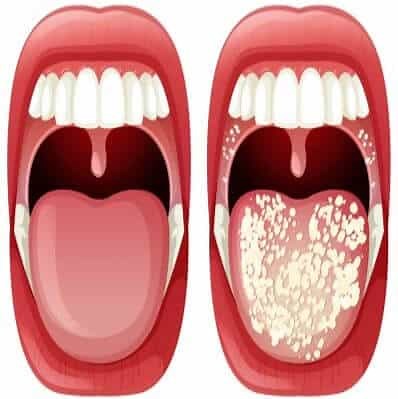 Candidiasis oral: ¿Cómo se contagia? Causas, síntomas y tratamientos