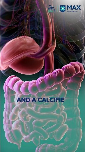 Gallbladder Stones and Cancer: Understanding the Risk