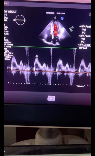 Grade II diastolic dysfunction #echocardiography https://youtu.be/1e3U1nh7xmY?si=U8ek2aU5VCR3jv_w