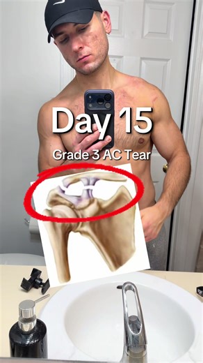 Progreso en la recuperación del tirón de clavícula