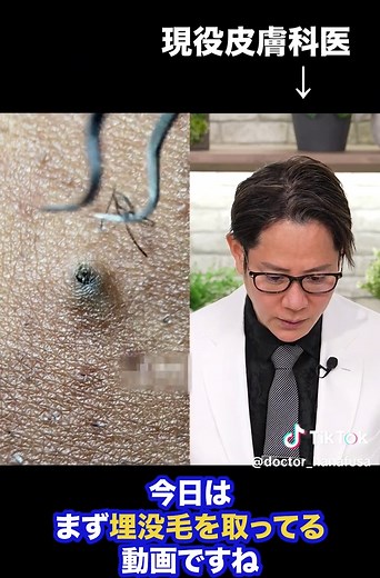 埋没毛について皮膚科医が解説