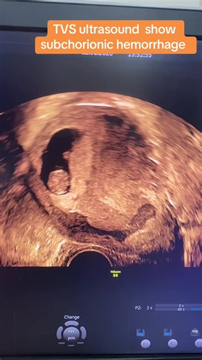 TVS ultrasound show subchorionic hemorrhage #ultrasound #drnafisha #bdtiktokofficial🇧🇩 #subchorionichemorrhage #pregnencyjourney