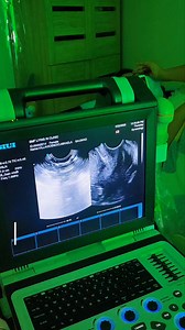 Sumaksesss🎉 Galing na daw si Mommy sa madaming clinic pero hindi daw makuha IUD nya na ikinabit after nya manganak via Ceasarian. Buti na lang andyan si Dra at may menstruation sya kaya na schedule si Mommy for Ultrasound guided IUD removal, nahirapan si Dra kunin dahil yung sinulid umikot na sa taas ng IUD🫣 Thank God success din🙏 #ultrasound #guide #iudremoval #fypシ゚ #fypシ゚viralシ #highlights | Shirly M. Formentos Lying In