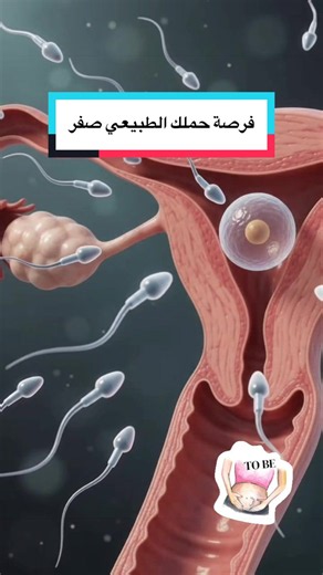 تأخر الحمل رغم انتظام الدورة وسلامة التحاليل؟ السبب قد يكون انسداد قناتي فالوب. : #تأخر_الحمل #انسداد_قنوات_فالوب #تأخر_الإنجاب #دكتورة_نسائية