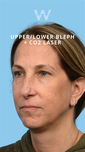 Jeffrey B. Wise, MD, FACS | Facial Plastic & Hair Restoration on Instagram: "This is a beautiful upper and lower blepharoplasty + CO2 laser result! The blepharoplasty takes care of heaviness and fullness, while the laser smooths fine lines and improves overall texture. When we combine these procedures together, we can brighten the eyes, smooth the lids, and tighten the surrounding skin all in one go. #belpharoplasty #upperblepharoplasty #lowerblepharoplasty #CO2laser #plasticsurgeon #plasticsurg