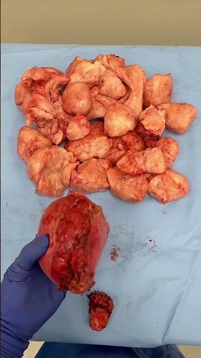 Robotic Hysterectomy: 8 Pounds of Fibroids Removed