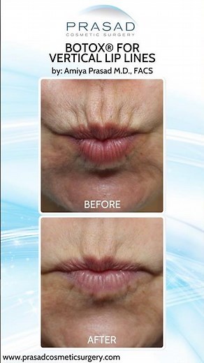 Treatments for Smokers Lines/ Vertical Lip Lines #botox