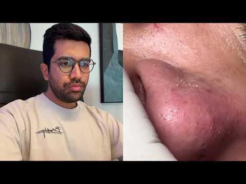 Blackheads and Sebaceous Filaments removal | Extraction Explained