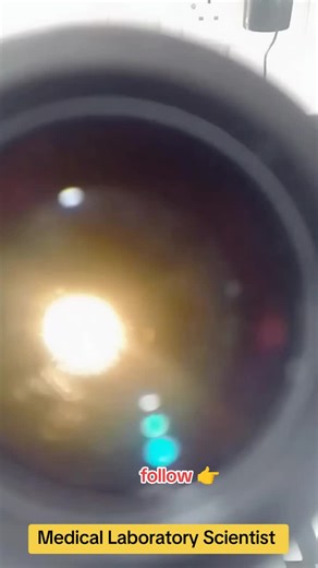 Understanding Entrobious Vermicularis in Stool Examination