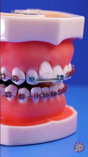 ¡Instalación de brákets de cerca: ¡tan satisfactoria! 🦷✨